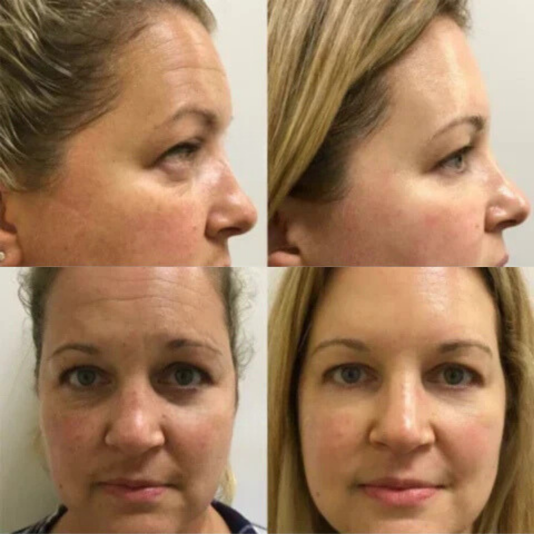 SkinLift™ - Botox Ansiktsserum Suddar Ut Linjer och Rynkor På Kort Tid