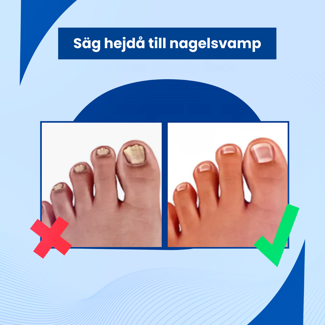 Keracure™ - Effektiv Behandling Mot Förtjockade Naglar
