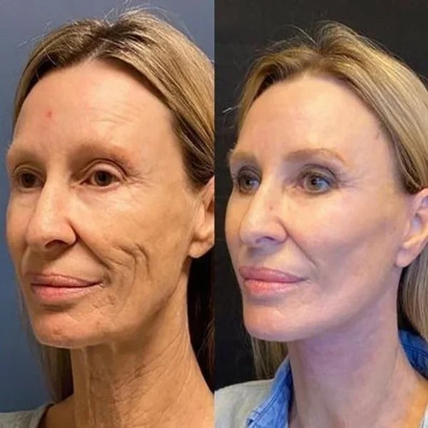 SkinLift™ - Botox Ansiktsserum Suddar Ut Linjer och Rynkor På Kort Tid