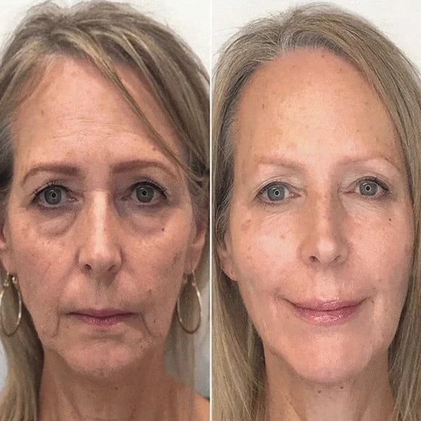 SkinLift™ - Botox Ansiktsserum Suddar Ut Linjer och Rynkor På Kort Tid