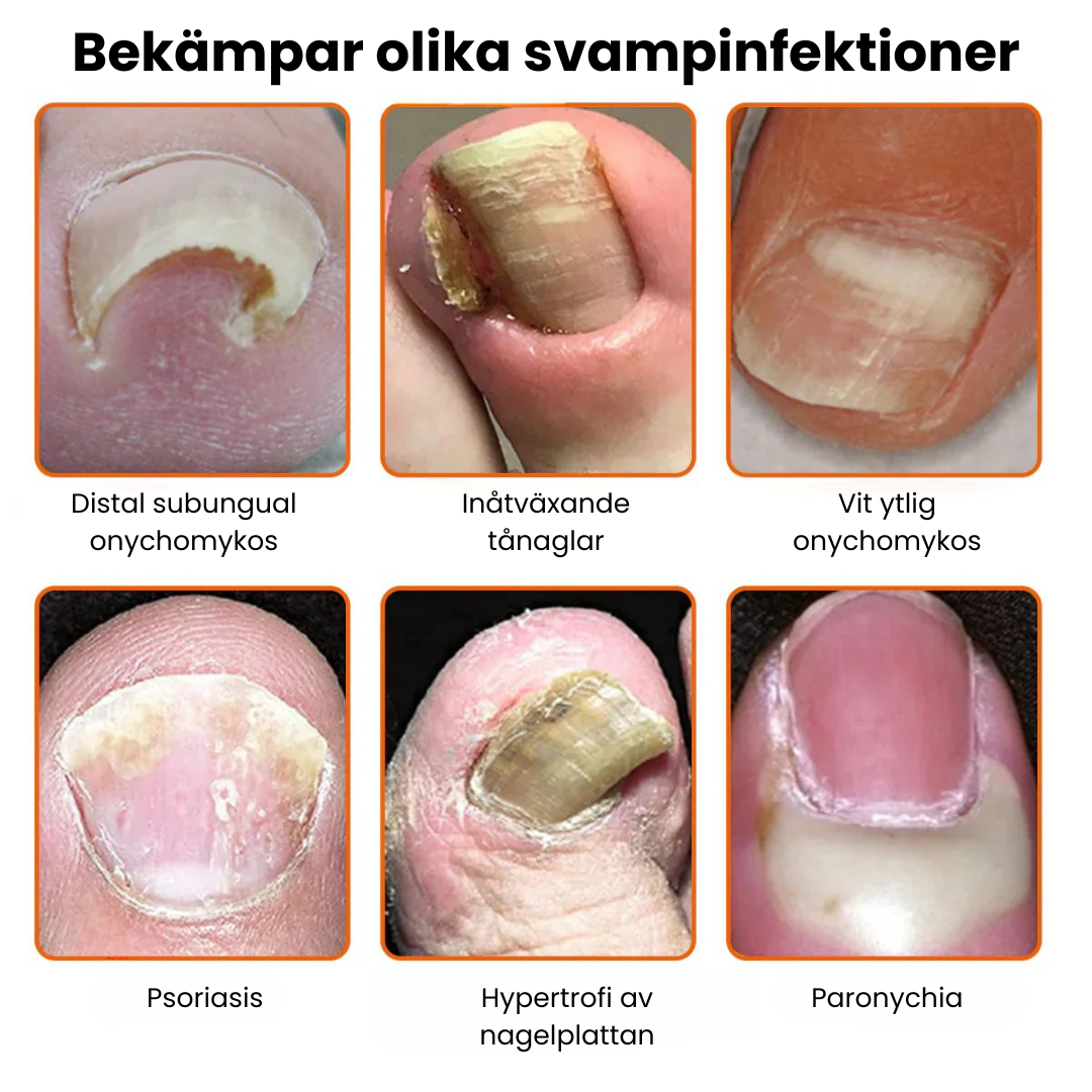 VenomCure™ - Bivengift Nagelsvamp Behandlingslösning