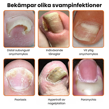 VenomCure™ - Bivengift Nagelsvamp Behandlingslösning