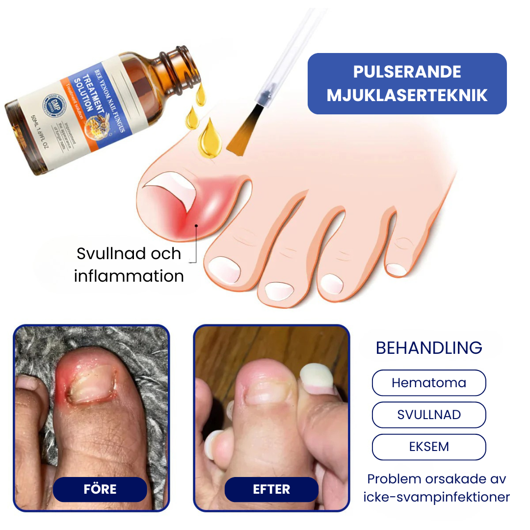 VenomCure™ - Bivengift Nagelsvamp Behandlingslösning