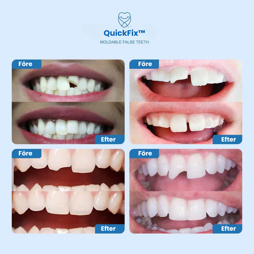QuickFix™ – Resin Tandreparationslim för Tillfällig Fyllning av Gap och Säker Tandreparation
