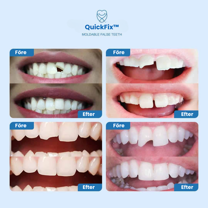 QuickFix™ – Resin Tandreparationslim för Tillfällig Fyllning av Gap och Säker Tandreparation