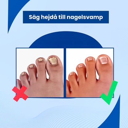 Keracure™ - Effektiv Behandling Mot Förtjockade Naglar