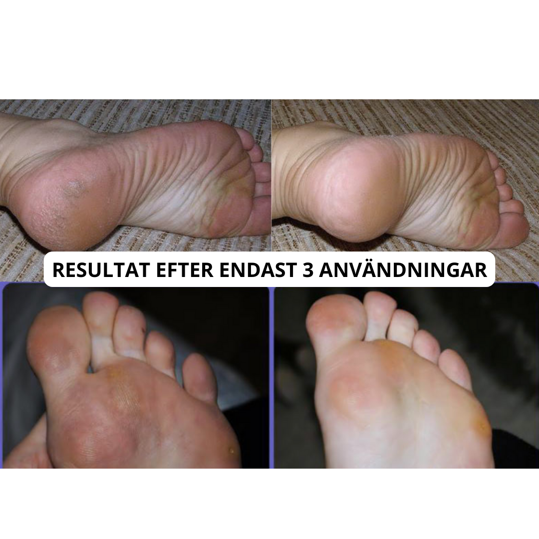 SmoothPro™ - Elektrisk Fotfil Pro