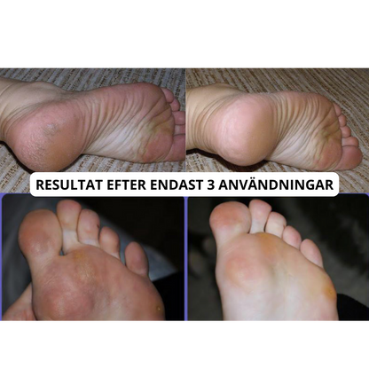 SmoothPro™ - Elektrisk Fotfil Pro