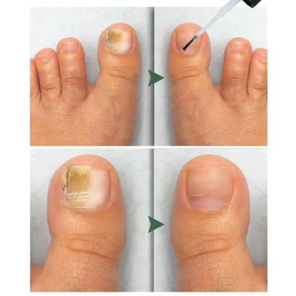 Nailuxe™ - Nagelskydd Med Bigiftbehandlingsserum För Starkare Och Hälsosammare Naglar