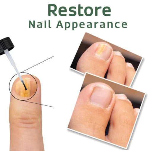 Nailuxe™ - Nagelskydd Med Bigiftbehandlingsserum För Starkare Och Hälsosammare Naglar