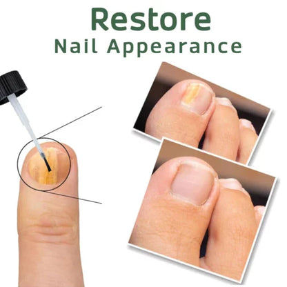 Nailuxe™ - Nagelskydd Med Bigiftbehandlingsserum För Starkare Och Hälsosammare Naglar