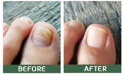 Nailuxe™ - Nagelskydd Med Bigiftbehandlingsserum För Starkare Och Hälsosammare Naglar