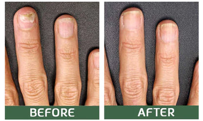 Nailuxe™ - Nagelskydd Med Bigiftbehandlingsserum För Starkare Och Hälsosammare Naglar